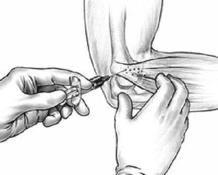 تزریق بوتاکس